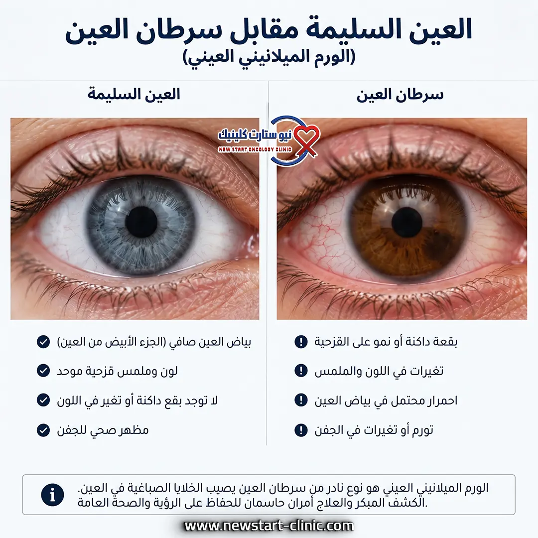 سرطان العين