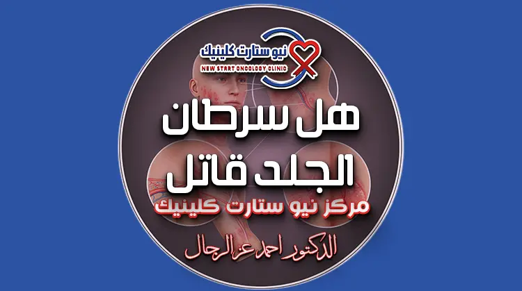 هل سرطان الجلد قاتل
