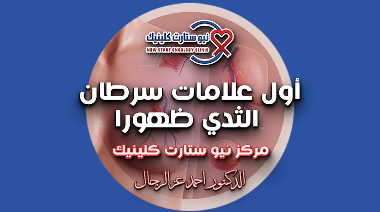 أول علامات سرطان الثدي ظهورًا
