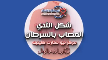 شكل الثدي المصاب بالسرطان