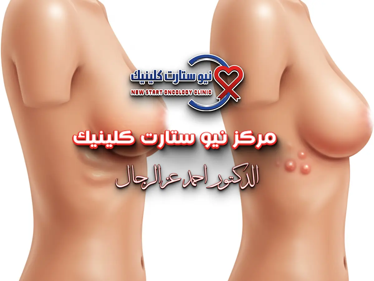 اعراض كانسر الثدى