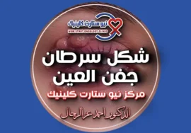 شكل سرطان جفن العين