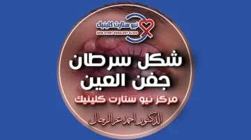 شكل سرطان جفن العين