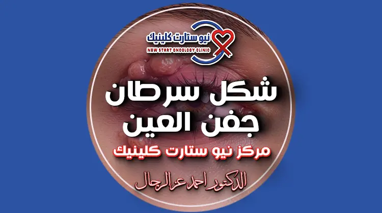 شكل سرطان جفن العين