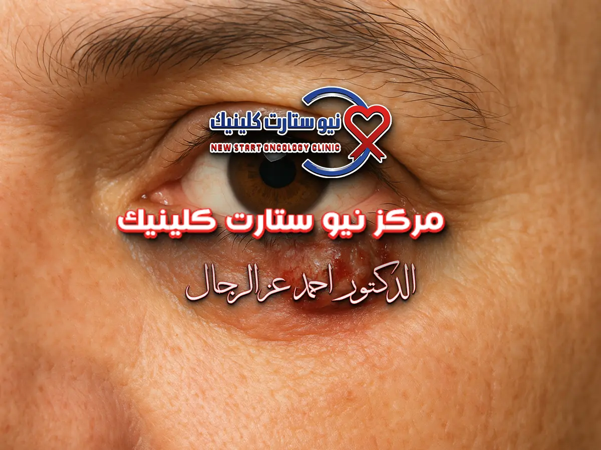 شكل سرطان جفن العين