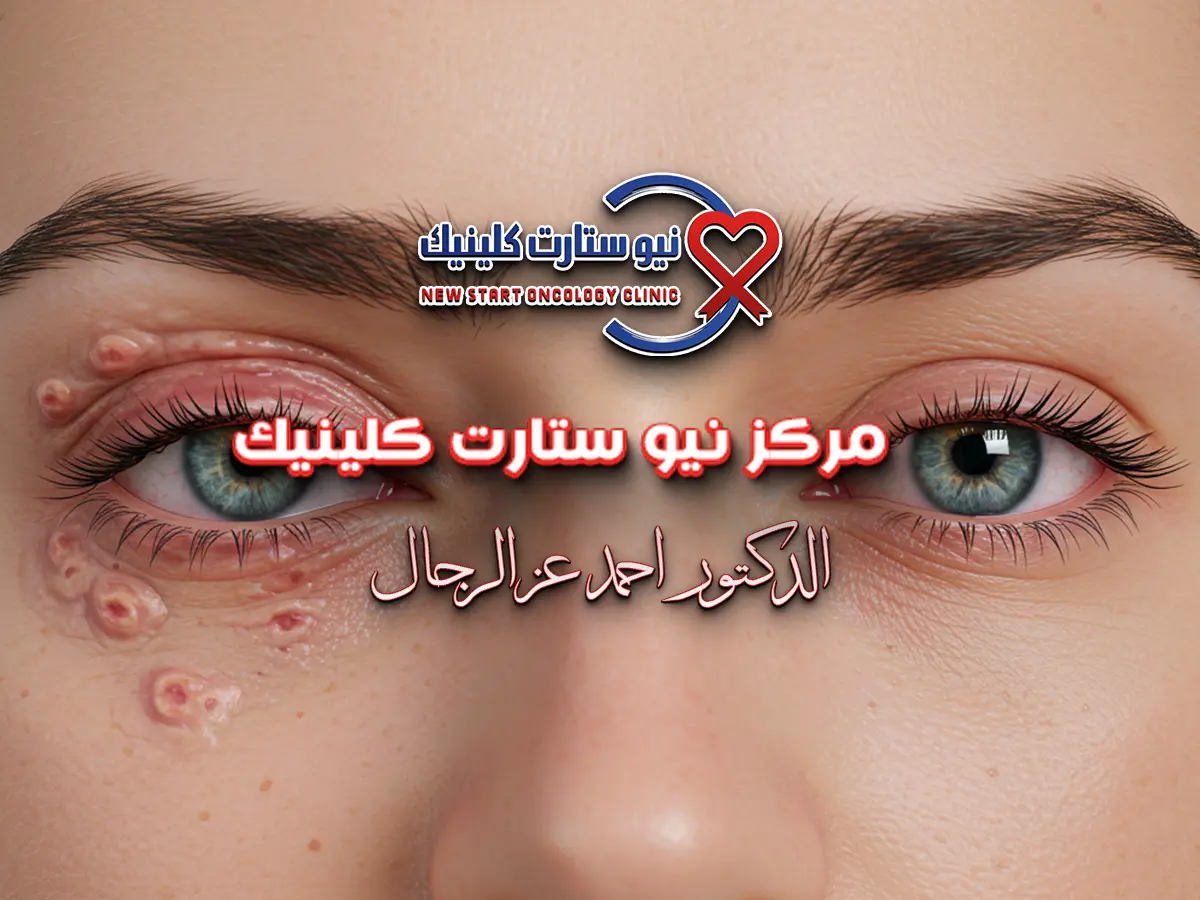 شكل سرطان جفن العين