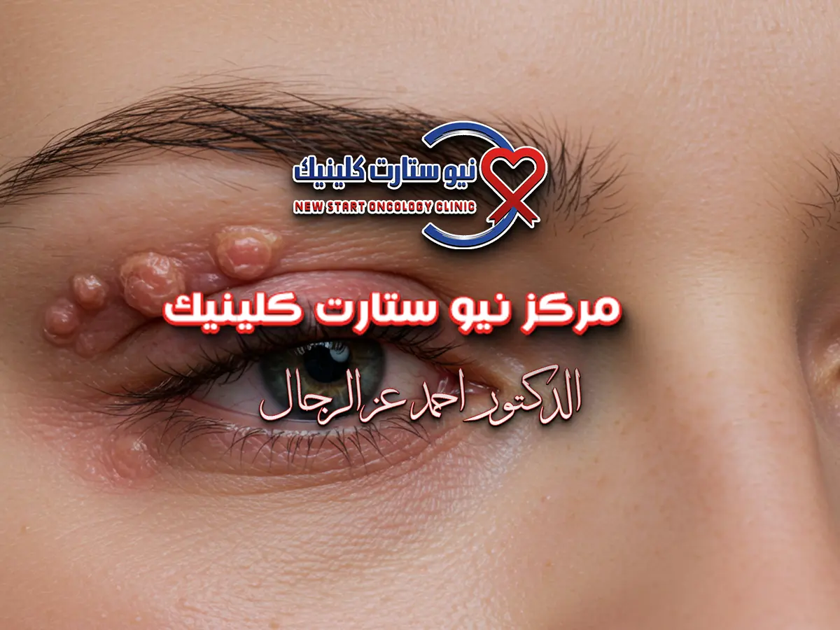 شكل سرطان جفن العين