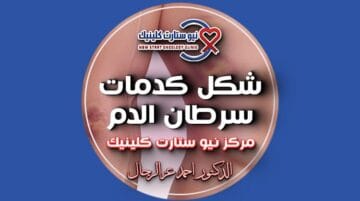 شكل كدمات سرطان الدم