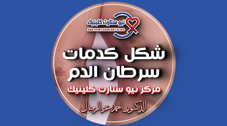 شكل كدمات سرطان الدم