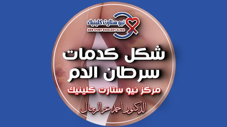 شكل كدمات سرطان الدم