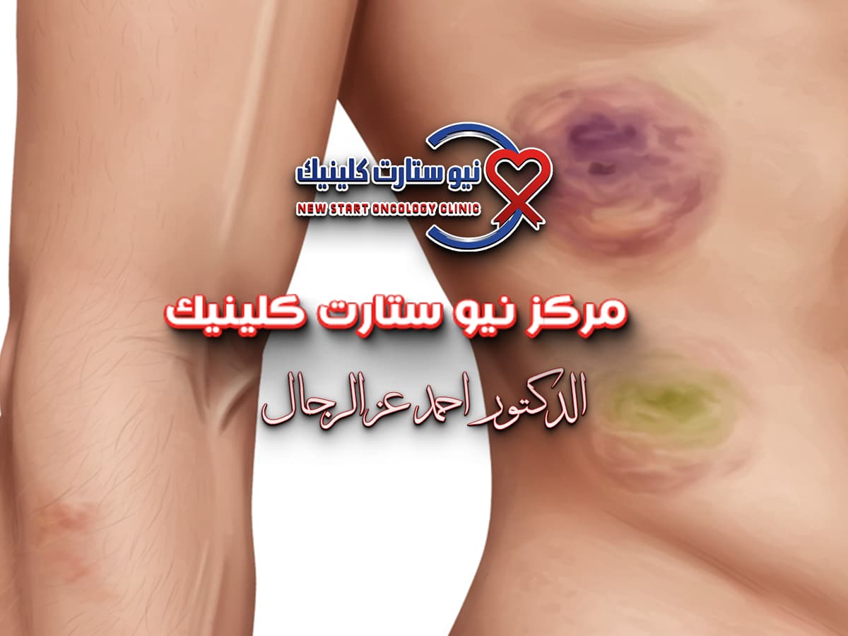 شكل كدمات سرطان الدم