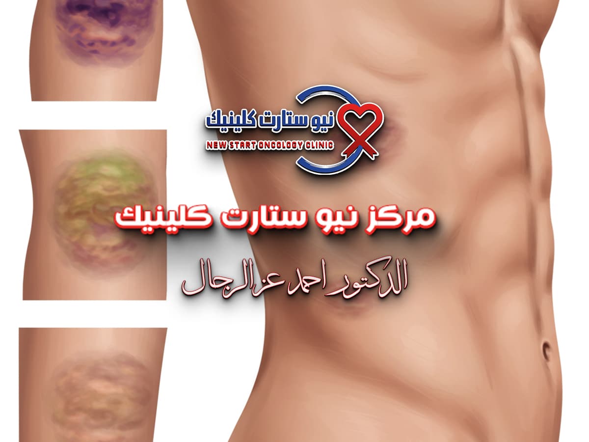 شكل كدمات سرطان الدم