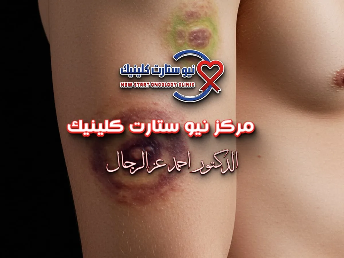 شكل كدمات سرطان الدم