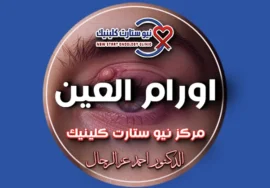 اورام العين