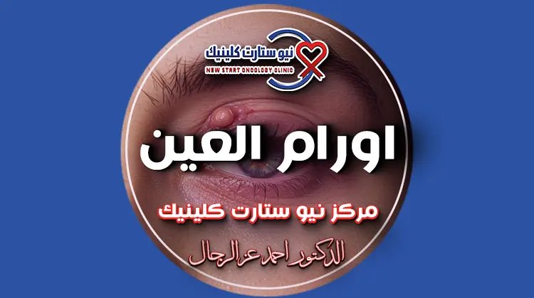 اورام العين