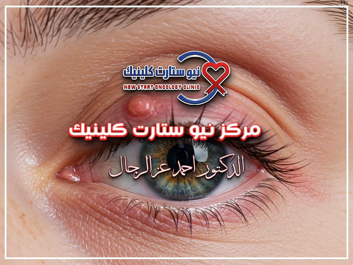 اورام العين