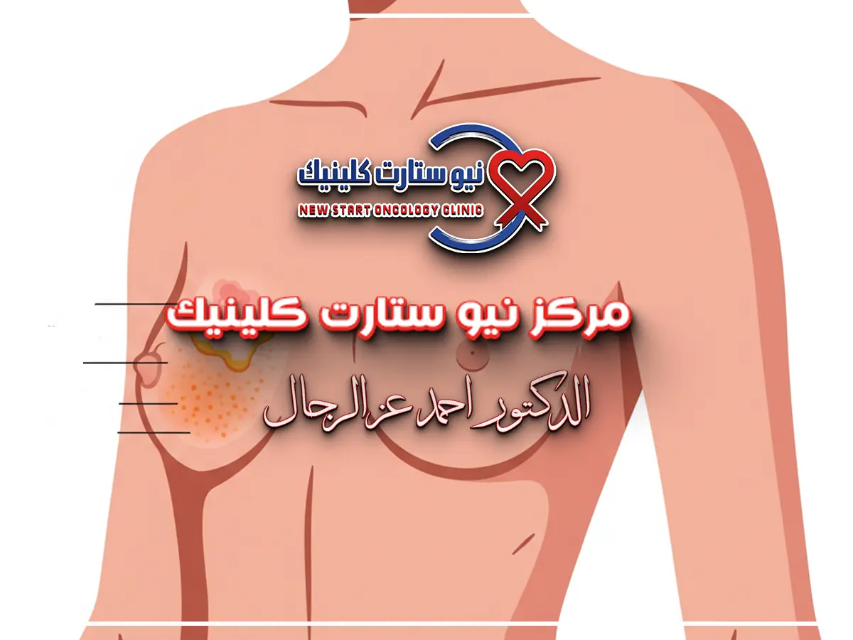 كيفية فحص الثدي