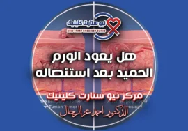هل يعود الورم الحميد بعد استئصاله