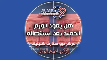 هل يعود الورم الحميد بعد استئصاله