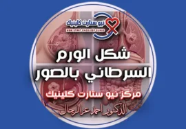 شكل الورم السرطاني بالصور