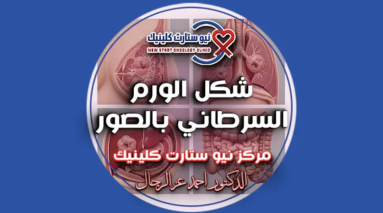 شكل الورم السرطاني بالصور