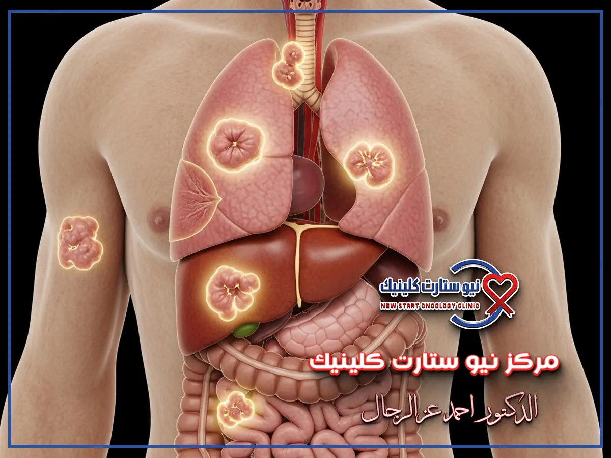 شكل الورم السرطاني بالصور