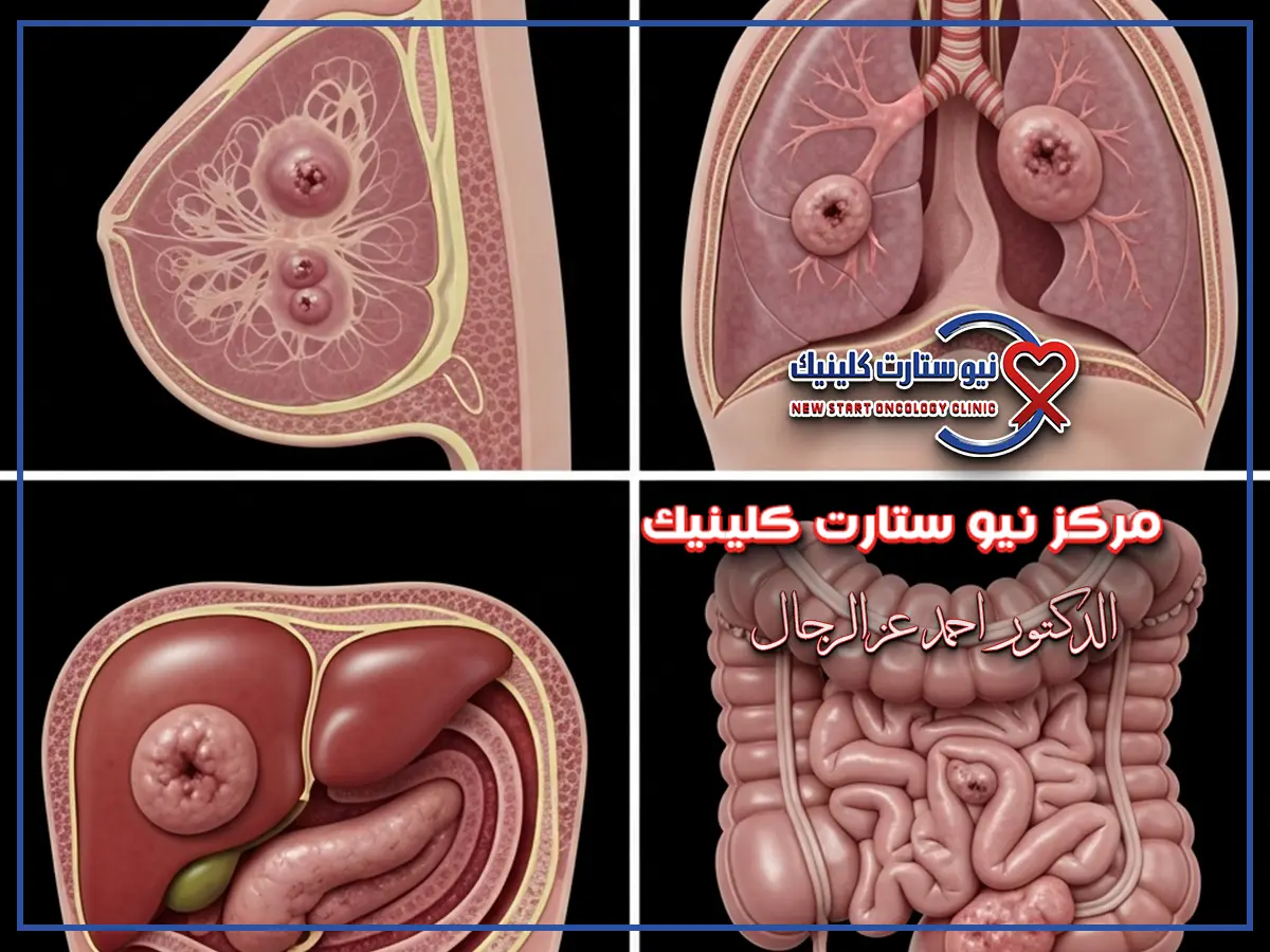 شكل الورم السرطاني بالصور
