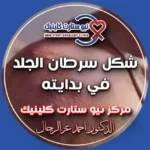 شكل سرطان الجلد في بدايته