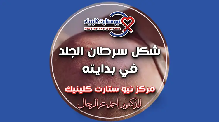 شكل سرطان الجلد في بدايته
