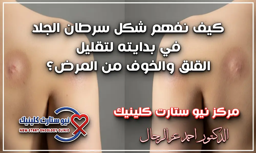شكل سرطان الجلد في بدايته