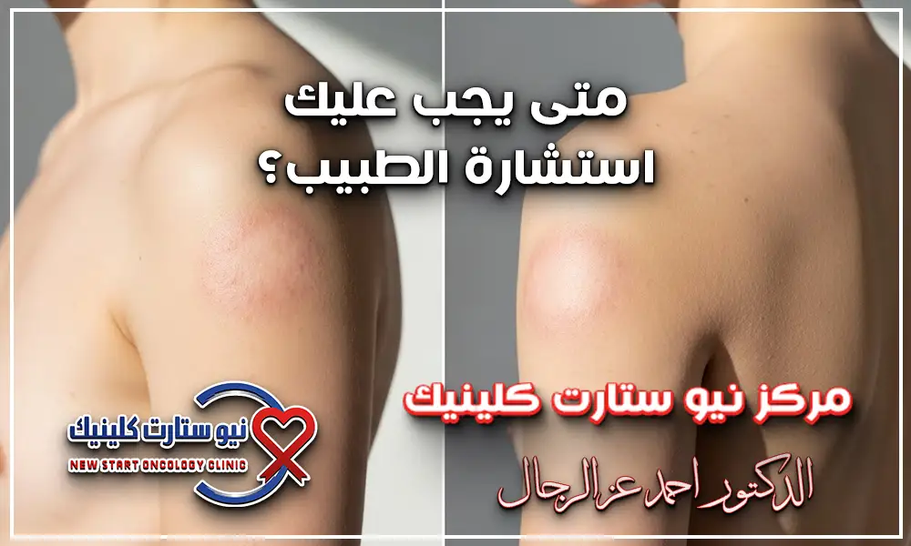 شكل سرطان الجلد في بدايته