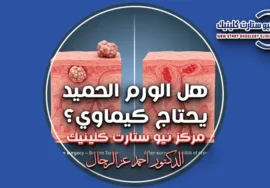 هل الورم الحميد يحتاج كيماوي
