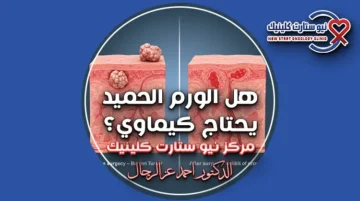 هل الورم الحميد يحتاج كيماوي