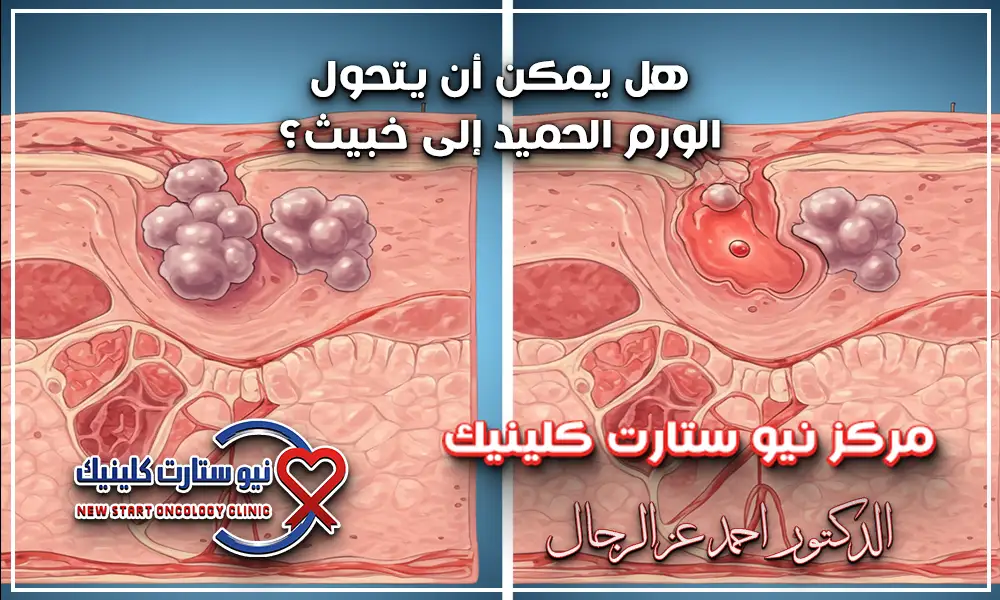 هل الورم الحميد يحتاج كيماوي