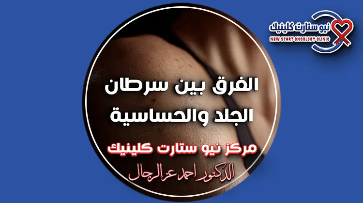 الفرق بين سرطان الجلد والحساسية