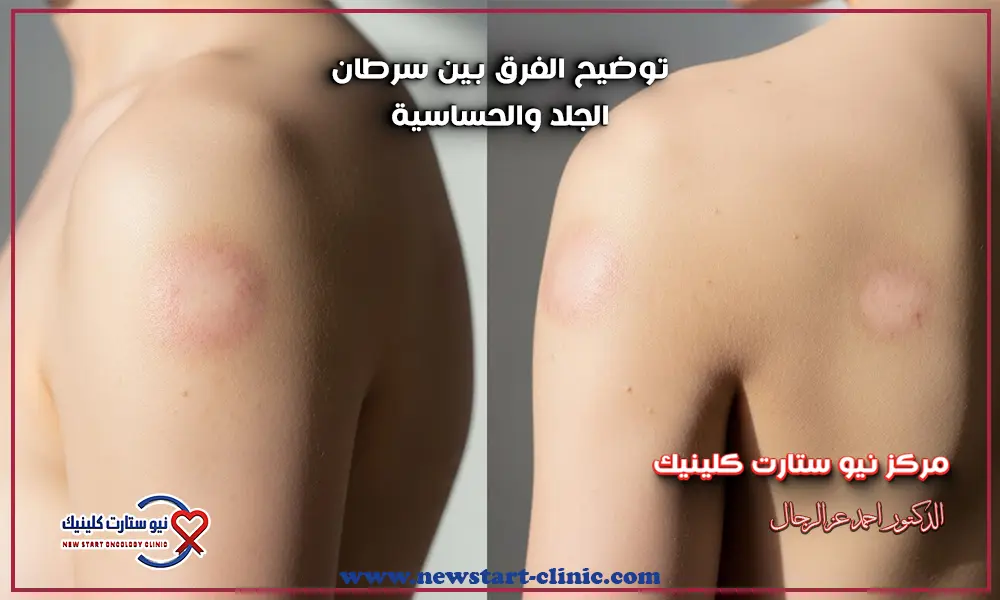 الفرق بين سرطان الجلد والحساسية