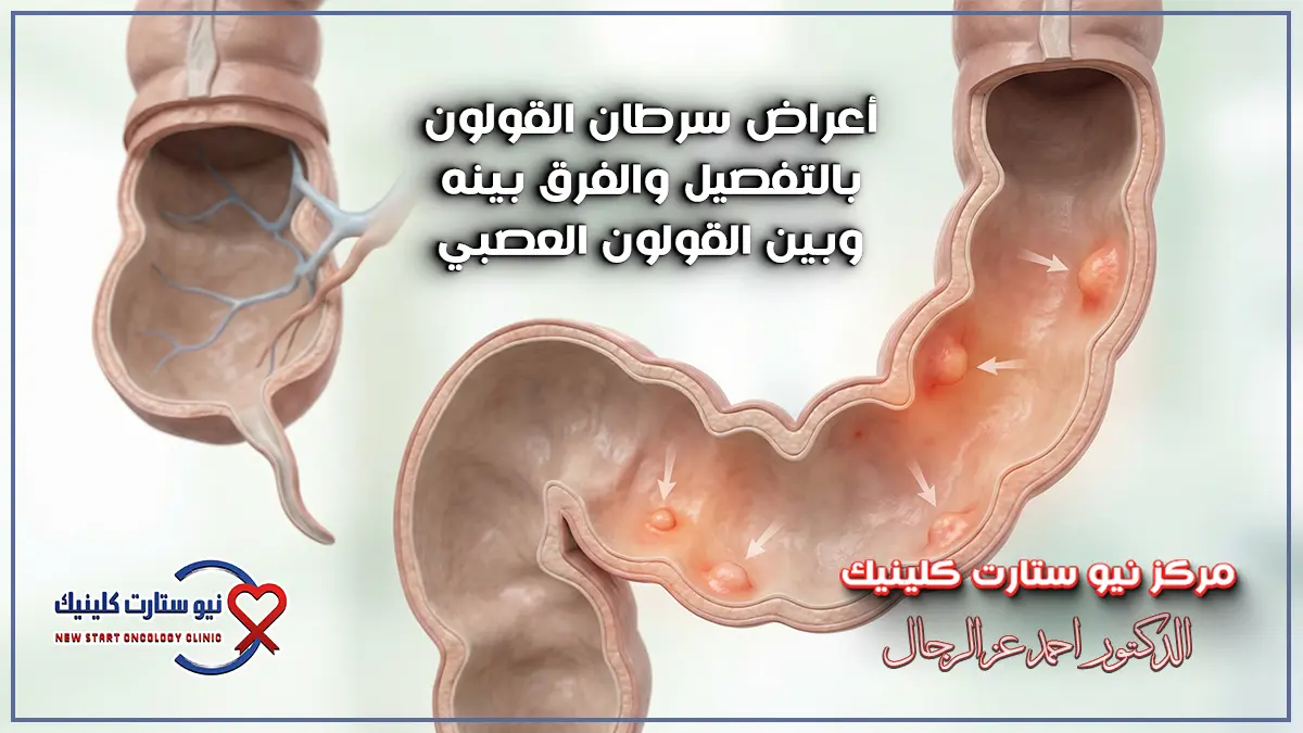 سرطان القولون