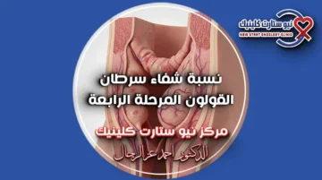 نسبة شفاء سرطان القولون المرحلة الرابعة