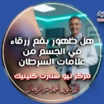 هل ظهور بقع زرقاء في الجسم من علامات السرطان