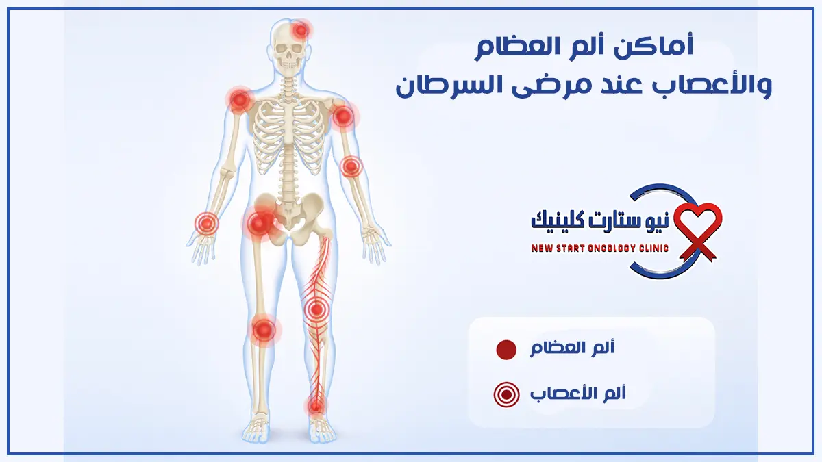 ألم العظام والأعصاب لمرضى الأورام