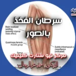 سرطان الفخذ بالصور