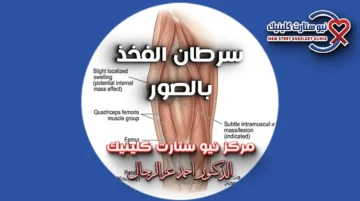 سرطان الفخذ بالصور