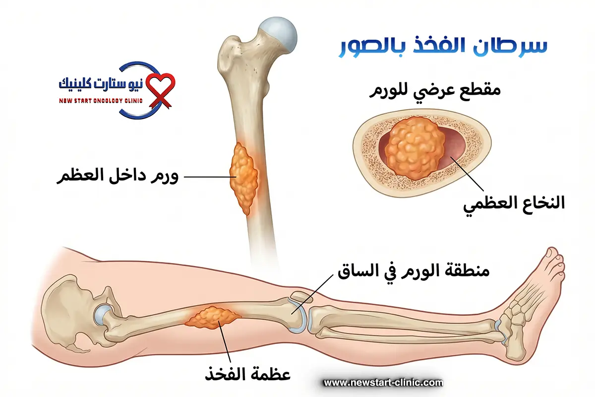 سرطان الفخذ بالصور