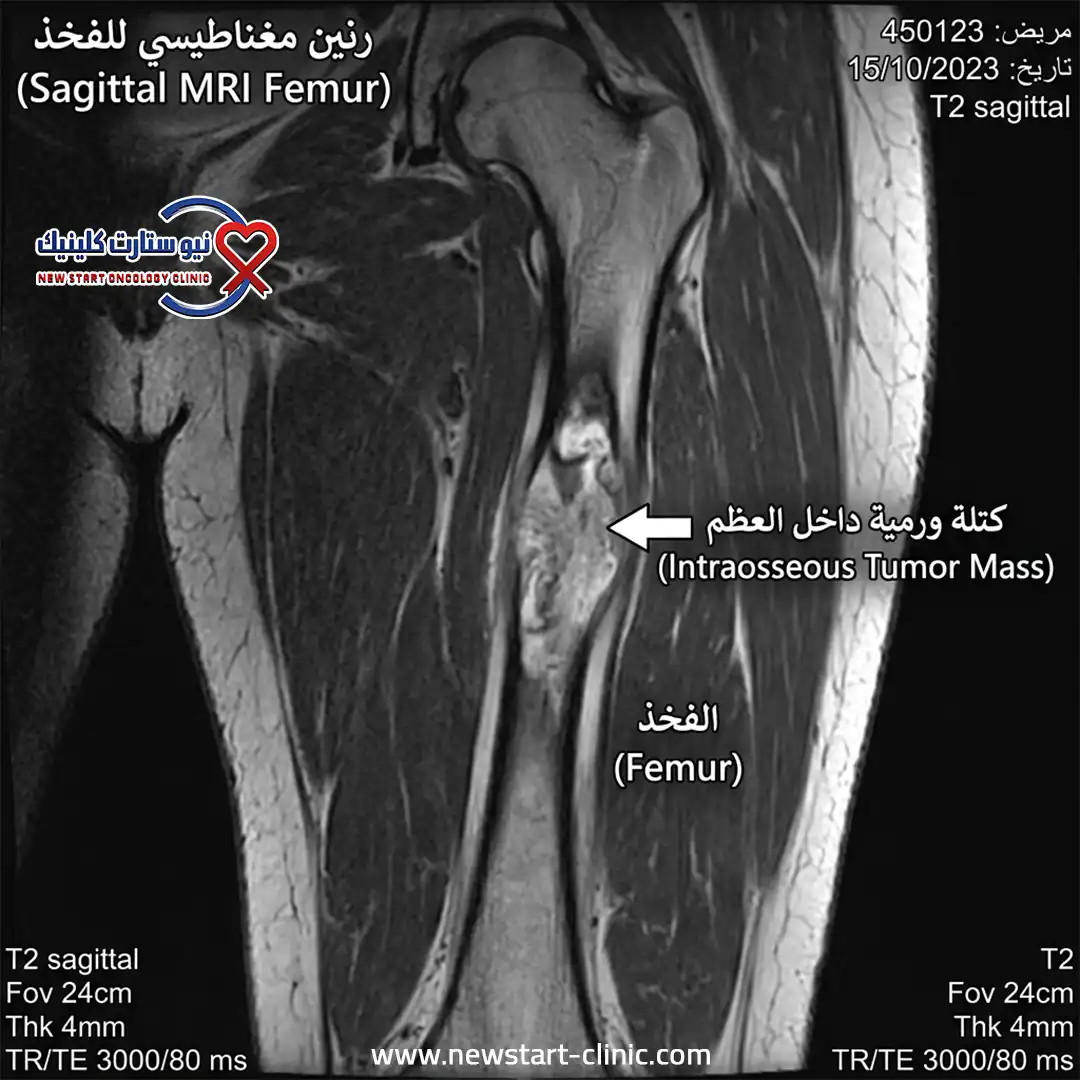 سرطان الفخذ بالصور