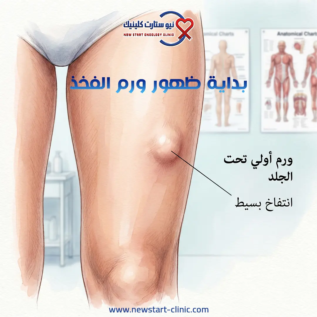 سرطان الفخذ بالصور