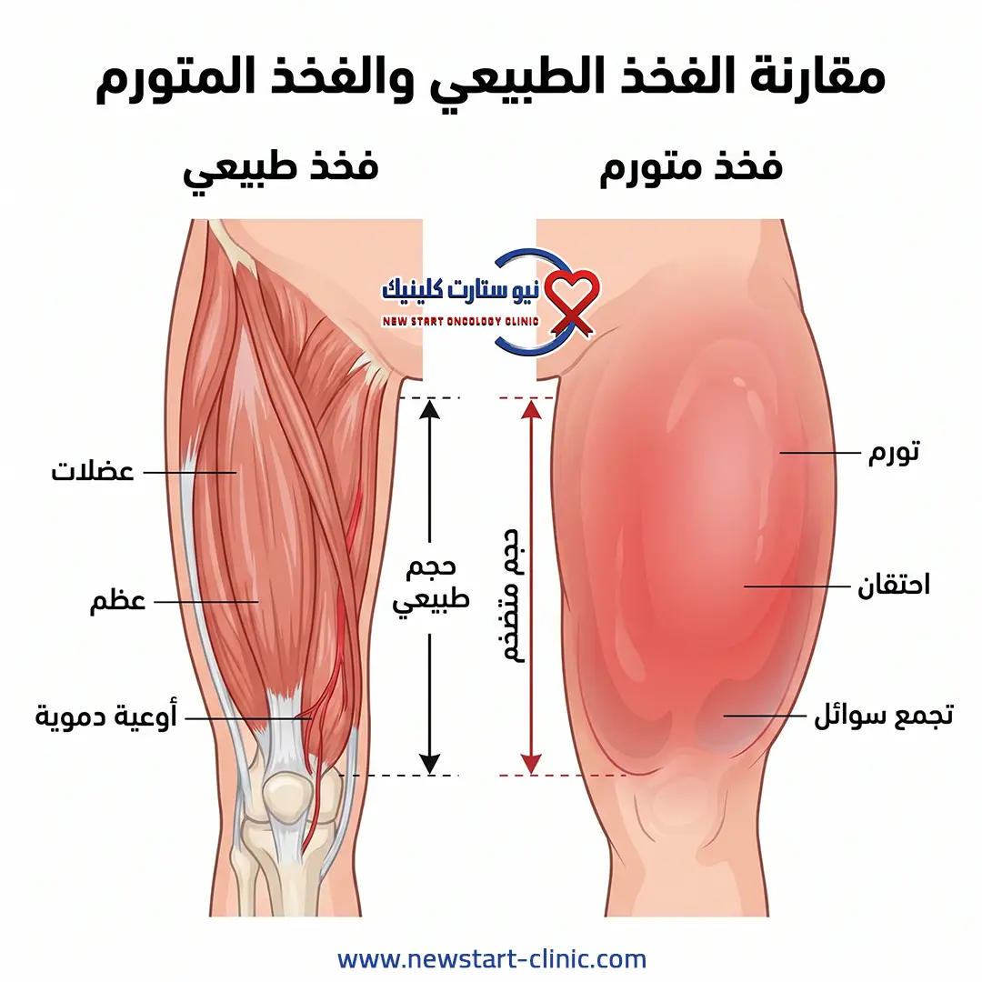 سرطان الفخذ بالصور