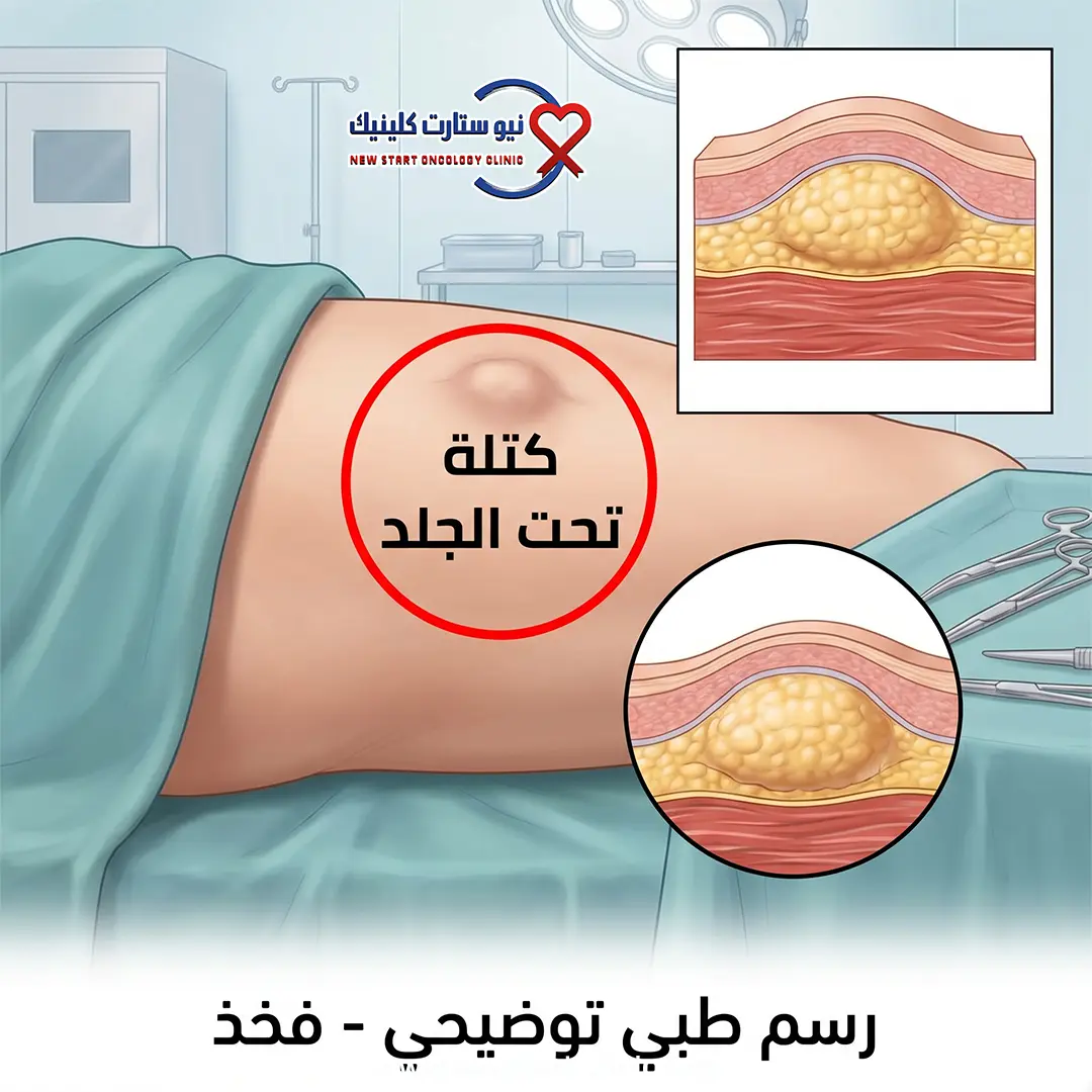 سرطان الفخذ بالصور