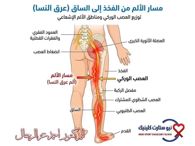سرطان الفخذ بالصور
