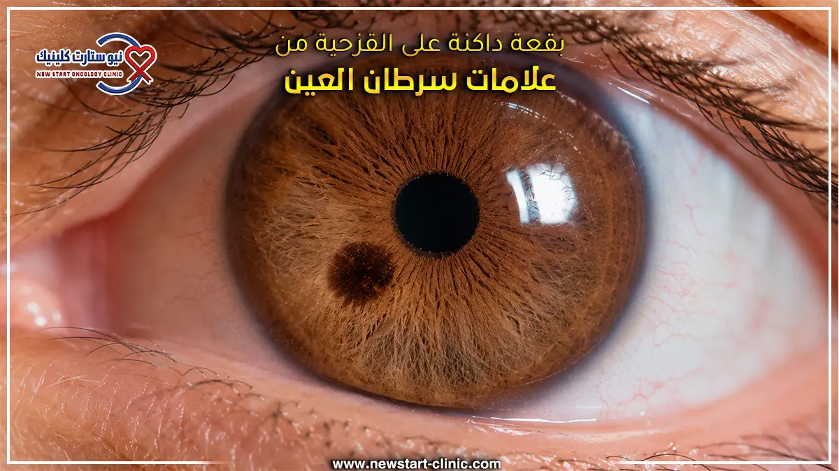 بقعة داكنة على القزحية من علامات سرطان العين