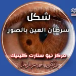 شكل سرطان العين بالصور
